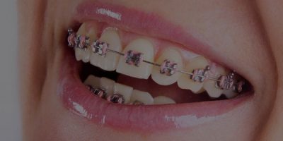 orthodontic-braces-guntersville-al
